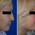 Rhinoplasty in McLean VA